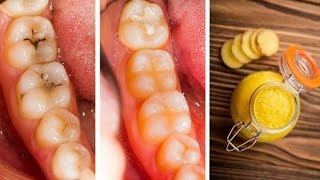 Remedies To Cure Cavities In 1 Day [upl. by Rifkin]