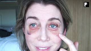 Blepharoplasty Video Diary  2 Weeks After Surgery 10 of 15 [upl. by Jovitah]