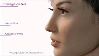 Rhinoplastie chirurgie du nez Marseille [upl. by Ahsienor]