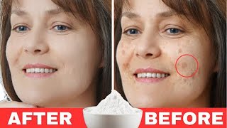 BAKING SODA Removes AGE SPOTS forever Just do THIS [upl. by Aseek]