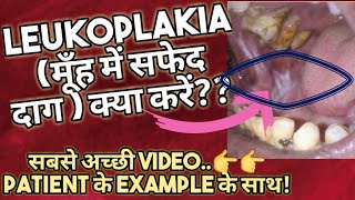 Leukoplakia in hindiमुँह में सफेद दाग हैं तो क्या ईलाज करेंTreatmentOral thrushOSMFOral Cancer [upl. by Candide]