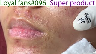 Acne Treatment Huong Da Nang 096  Loyal fans  Super product [upl. by Diaz]