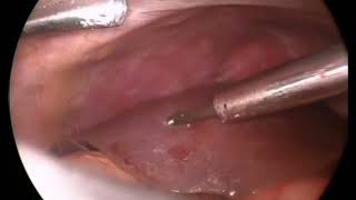 Laparoscopic Cholecystectomy 24 [upl. by Rayford]