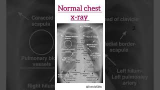 Normal chest xray  shortsvideo xray normalxray [upl. by Yerxa]