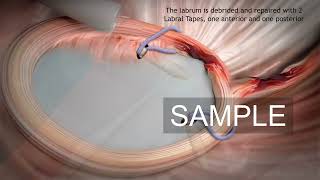 Shoulder arthroscopy stock 3D animation [upl. by Edmond]