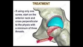 Slipped Capital Femoral Epiphysis  Everything You Need To Know  Dr Nabil Ebraheim [upl. by Heilner302]