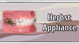 Herbst Appliance [upl. by Sands]