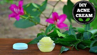 DIY Acne amp Acne Scar Removal Cream That Really Works CLINICALLY PROVEN [upl. by Nythsa782]