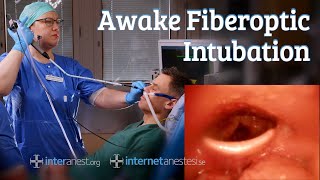 Awake Fiberoptic Intubation [upl. by Maeve]