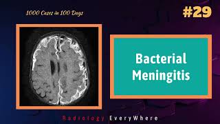 Bacterial Meningitis Radiology Video  1000 cases in 100 days  Video 29  CNS infections [upl. by Benton984]