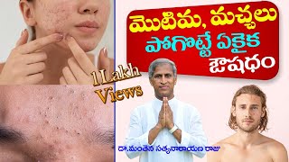 How To Remove Pimples Overnight  Acne Treatment  Dr Manthena Satyanarayana Raju  GOOD HEALTH [upl. by Nerac]