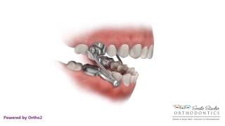 Herbst  Orthodontic Appliance [upl. by Rodgiva]