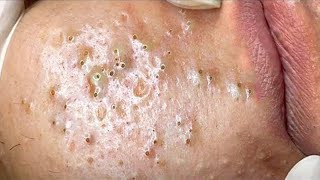 Big Cystic Acne Blackheads Extraction Blackheads amp Milia Whiteheads Removal Pimple Popping  3922 [upl. by Krisha84]