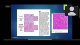 Poorly differentiated thyroid cancer management PDTC  Practical Implications Dr Saumyta [upl. by Wollis]