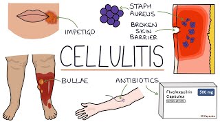 Understanding Cellulitis Skin and Soft Tissue Infections [upl. by Agemo]