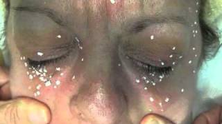 Get rid of Syringoma today [upl. by Shandee]