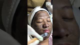 THE CARBON PICO LASER POPULAR SKIN TREATMENT [upl. by Hillman22]