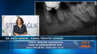 Kanal tedavisi sırasında dişte delinme perforasyon [upl. by Fabrin]