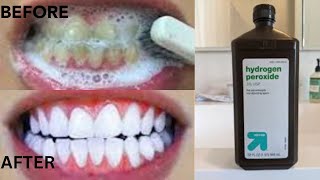 How To Get White Teeth In Just 2 Minutes With Hydrogen PeroxideWhite Teeth HACK [upl. by Dominica]