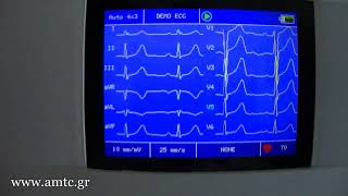 Contec 300G ECG  printing demo [upl. by Gittel]