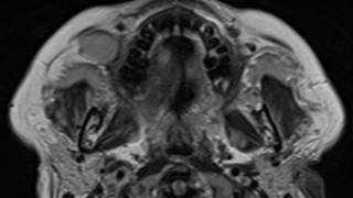 Venous Malformations [upl. by Devitt]