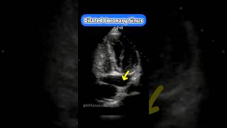 Coronary Sinus on Echocardiography echocardiogram cardiology echo [upl. by Lamarre]