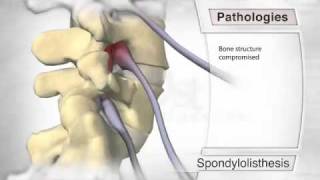 Spondylolisthesis Pathology [upl. by Eseeryt]