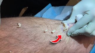 ARE THESE THE BEST PIMPLE POPS OF 2022  5 New Pimple Popping Videos 2022 [upl. by Attesoj602]