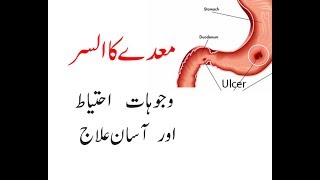 How To Cure Stomach Ulcer In UrduHindiStomach Ulcer Treatment [upl. by Droffig]