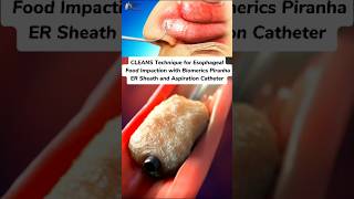 CLEANS Technique for Esophageal Food Impaction medical animation 3d short [upl. by Ahnavas]