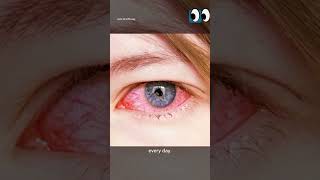 Topic Conjunctivitis  adibarani6113 [upl. by Alocin]