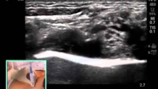 Ultrasound Guided Infraclavicular Nerve block [upl. by Iznekcam]