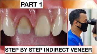 Step by Step 2 Indirect Veneer with Discoloration Tooth Part 1  General Dentist Griya RR [upl. by Myrle]