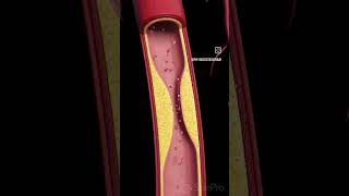 Arteriosclerosis means “hardening of the arteries” [upl. by Constance746]