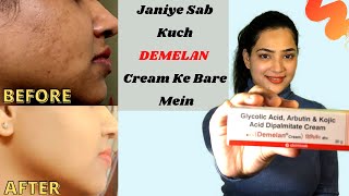 DEMELAN CREAM REVIEW  हिंदी में  My 1 Month Experience With Demelan Cream  Before amp After [upl. by Beore]