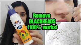 HOW TO REMOVE BLACKHEADS PERMANENTLY  EASY AND PAINLESS METHOD [upl. by Wash]