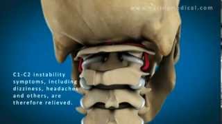 C1 and C2 Atlantoaxial Instability Upper Cervical Instability and Prolotherapy animation [upl. by Abshier717]