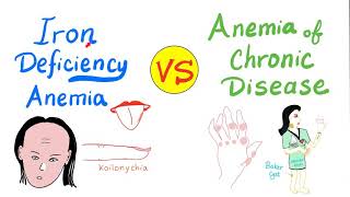 Iron Deficiency Anemia IDA VS Anemia of chronic disease ACD [upl. by Skardol859]