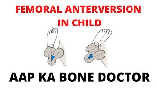 FEMORAL ANTEVERSION IN CHILD  EPISODE 55 [upl. by Namhcan]