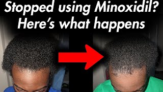 This happens when quitting Minoxidil Experiment [upl. by Assilana]