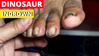 Ingrown Toenail Treatment  Almas Manicure and Pedicure Vlogs [upl. by Torrance854]