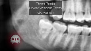 Three Roots Mandibular Wisdom Tooth Extraction Step by Step Dental Extraction [upl. by Diva778]