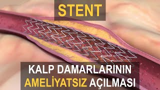 STENT NEDİR  Stent Nasıl Takılır [upl. by Elletnuahs]