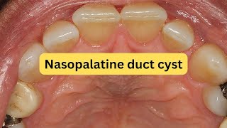 What is nasopalatine duct cyst EASY [upl. by Smart]