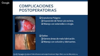ENFERMEDADES DEGENERATIVAS PINGUECULA Y PTERIGION [upl. by Beedon]