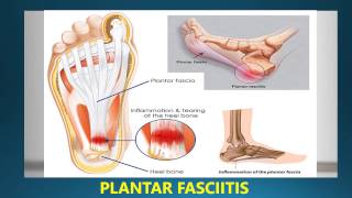 Best Insoles For Plantar Fasciitis Reviews [upl. by Martinsen]