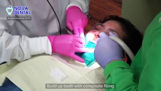 Nova Dental Arlington Composite Filling by Dr Hawoon Kim [upl. by Braeunig]