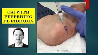 Video  plantar fibroma with CSI peppering [upl. by Ibed]