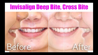 Invisalign【Cross Bite Deep bite】Non Extraction Approach [upl. by Ragucci]