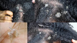 My Seborrheic Dermatitis my scalp up close [upl. by Oicnecserc243]